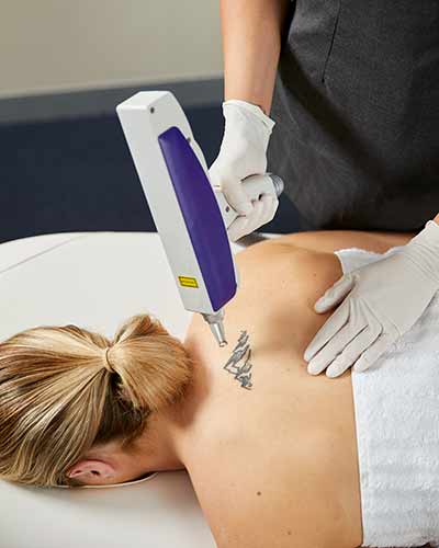 Laser-Tattoo-Removal-In-Use